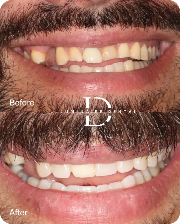 Our Patient Transformed Smiles​